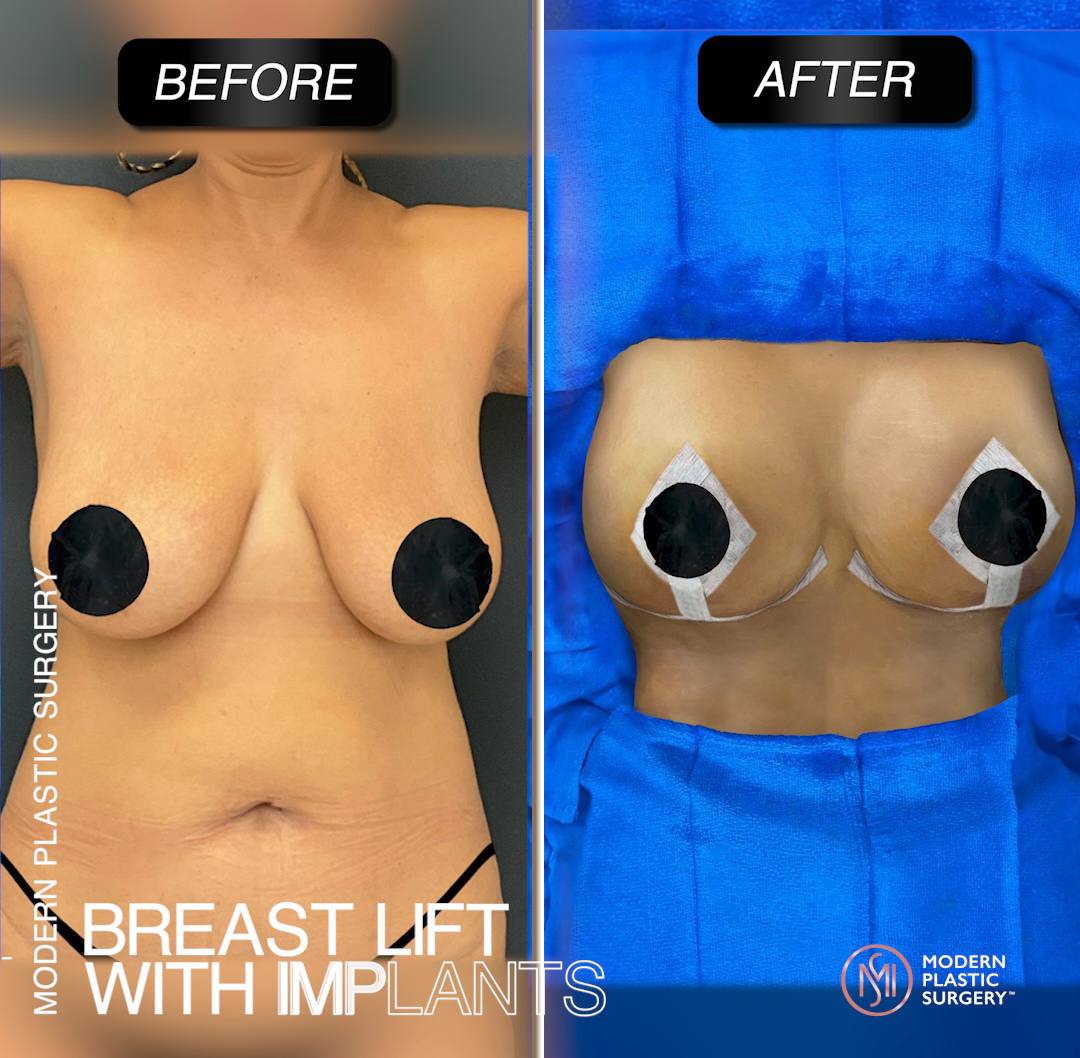 before-and-after-breast-lift-modern-plastic-surgery-miami