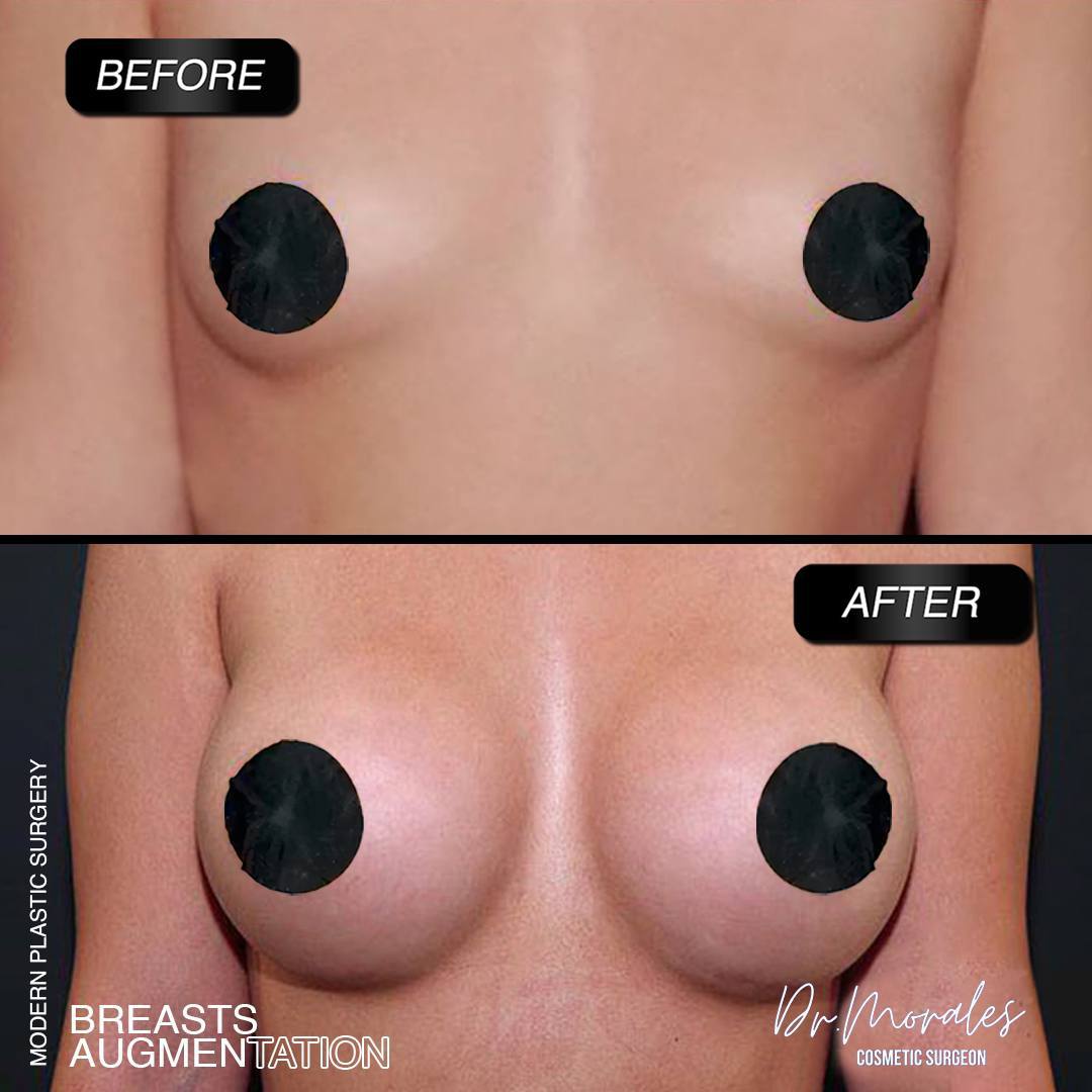 breast-augmentation-1-modern-plastic-surgery