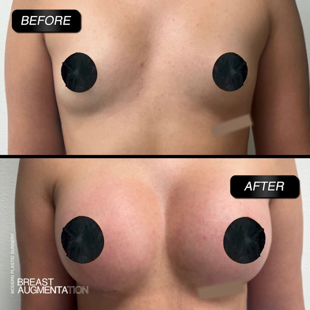 breast-augmentation-before-after-modern-plastic-surgery-miami