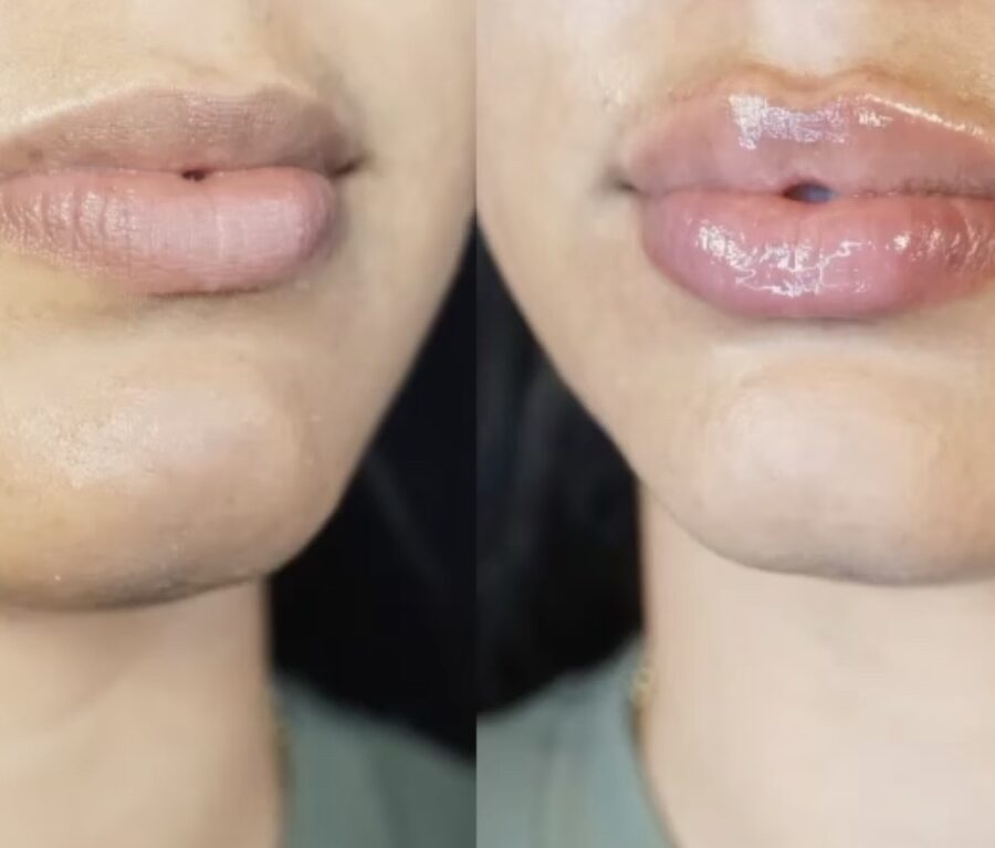 lip-filler-modern-plastic-surgery