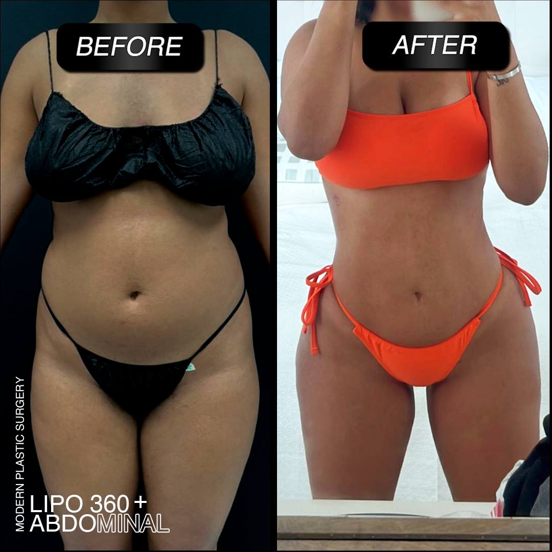 lipo-360-before-after-modern-plastic-surgery-miami