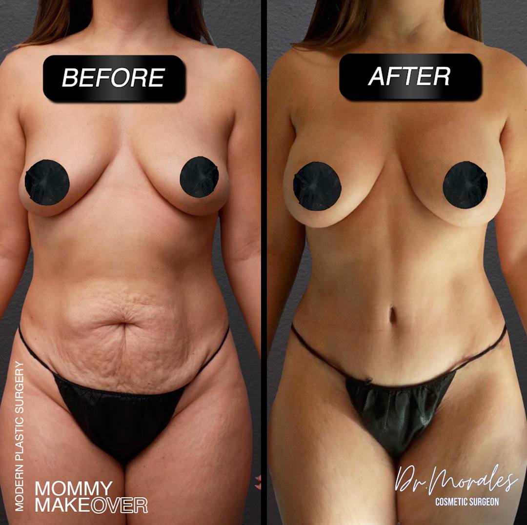 mommy-makeover-modern-plastic-surgery-miami